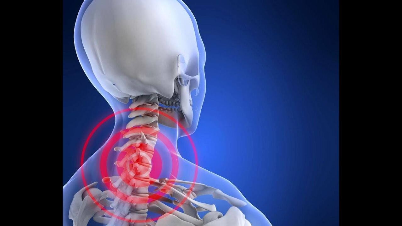 Osteocondrosi della colonna cervicale