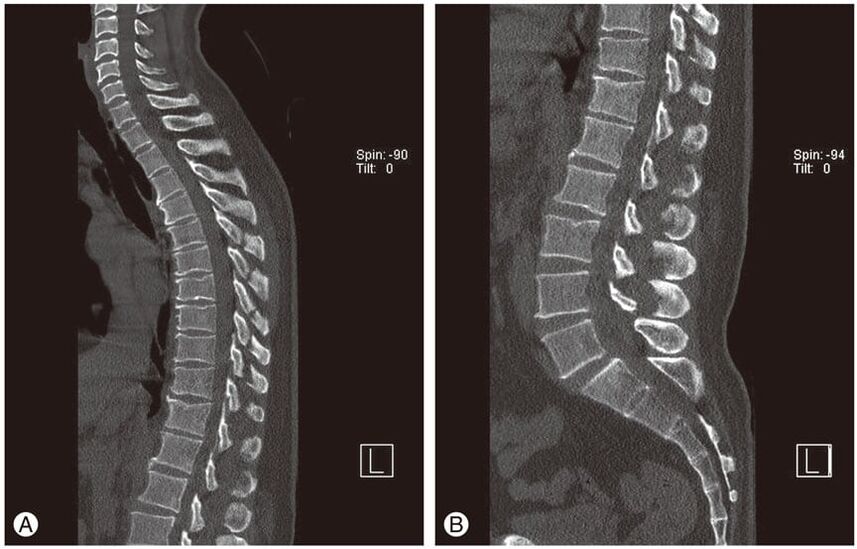 Deformazione dei dischi intervertebrali su immagini MRI nell'osteocondrosi toracica