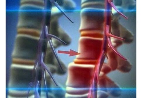 Spremitura delle terminazioni nervose nell'osteocondrosi lombare