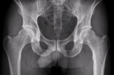 Opzioni diagnostiche per l'artrosi dell'articolazione dell'anca