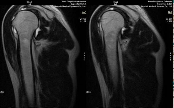 radiografia per diagnosticare l'artrosi della spalla