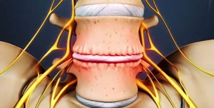 lesioni spinali dovute a osteocondrosi