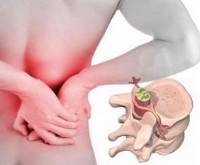 Lombalgia all'inizio della malattia osteocondrosi